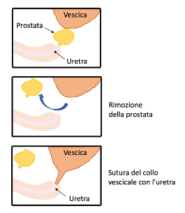 Figura 1. Step della prostatectomia radicale